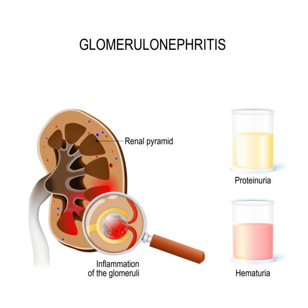 illustrazioni stock, clip art, cartoni animati e icone di tendenza di glomerulonefrite (nefrite glomerulare) - glomerulus
