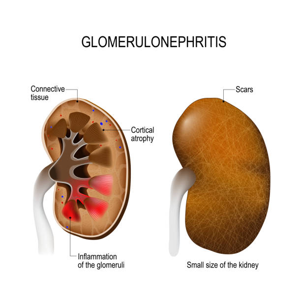 гломерулонефрит. признаки и симптомы. - glomerulus stock illustrations