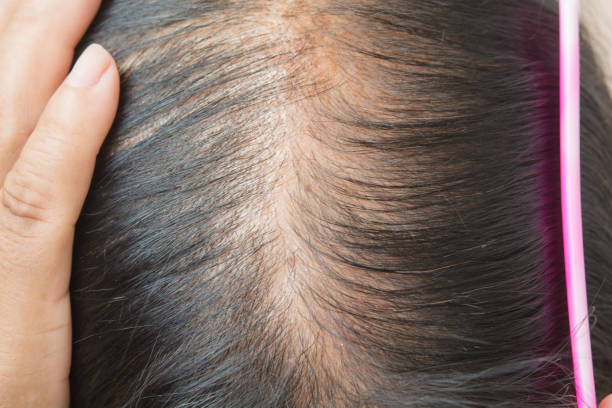 Thin Hair And Scalp And Broken Hair Stock Photo - Download Image Now - Hair,  Women, Human Scalp - iStock