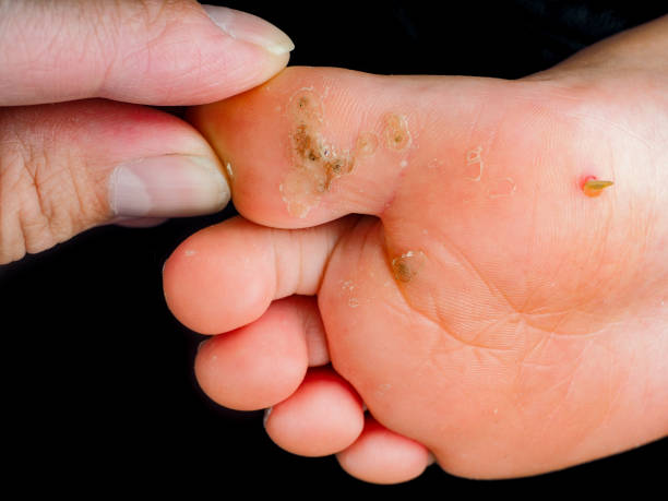 Child's foot sole, with verruca, wart,  callus isolated towards black. Touched by fingers of a pediatrician, doctor stock photo