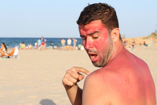 istock Man suffering the harmful effects of sunbathing 1002075940