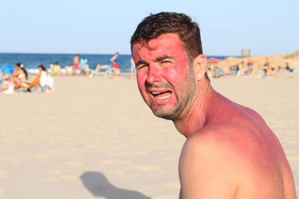 istock Man with redness crying at the beach 1002075956