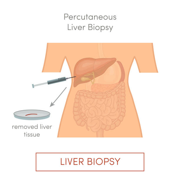 perkutane leberbiopsie - biopsie stock-grafiken, -clipart, -cartoons und -symbole