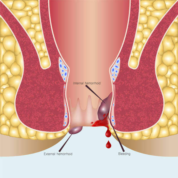 hemoroidy wewnętrzne i hemoroidy zewnętrzne - hemorrhoid stock illustrations