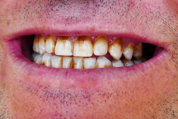 放置歯黄ばみ歯、口腔の健康と歯 - yellowed ストックフォトと画像