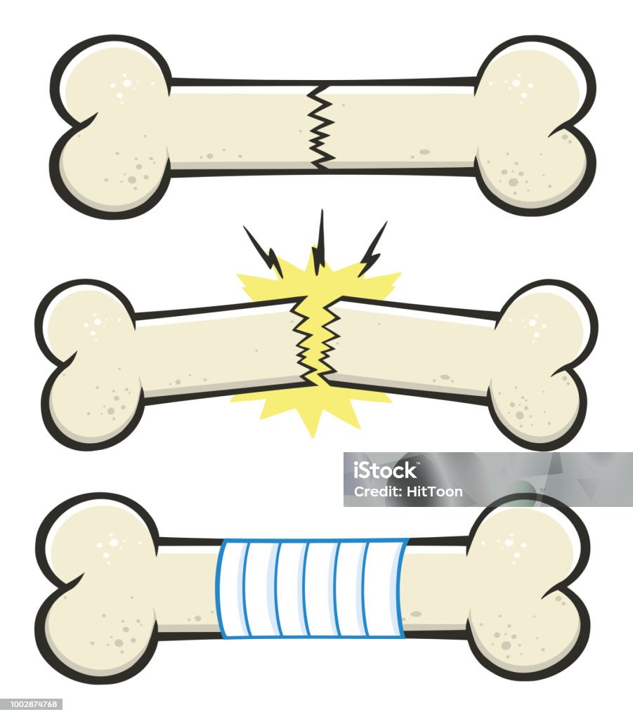 Ilustración de Hueso Fractura Línea Dibujos Animados Dibujo Diseño Sistema 2 Colección De Vector y más Vectores Libres de Derechos de Adulto - iStock Ilustración de Hueso Fractura Línea Dibujos Animados Dibujo Diseño Sistema 2 Colección De Vector y más Vectores Libres de Derechos de Adulto - iStock