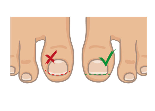 ilustrações de stock, clip art, desenhos animados e ícones de how to cut toenails, right and wrong concept. how to avoide ingrown nail. female or male foot sole, barefoot, top view. vector illustration, hand drawn cartoon style isolated on white. - reflexology pedicure massaging human foot