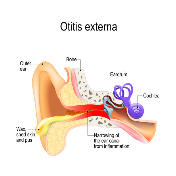 Swimmer's ear. Otitis externa Swimmer's ear. Otitis externa is inflammation of the ear canal. Human anatomy. Vector illustration for medical use ear drumm stock illustrations