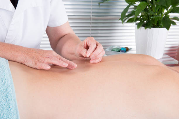 alternative medizin nahaufnahme männlich zurück mit stahl nadeln bei der akupunktur-therapie - alternative medicine massaging spa treatment back stock-fotos und bilder