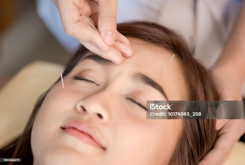 아름다움을 침술 살롱에서 머리에 침술 치료를 수행 하는 손의 근접 촬영 침술 치료 건강 스파입니다 침술에 대한 스톡 사진 및 ...