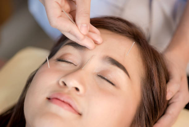 Acupuncture beauty: Closeup of hand performing acupuncture therapy on head at salon; acupuncture treatment ; health spa. stock photo