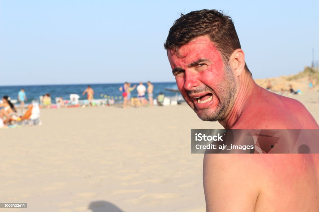 White man at the beach during heatwave White man at the beach during heatwave. Sunburned Stock Photo