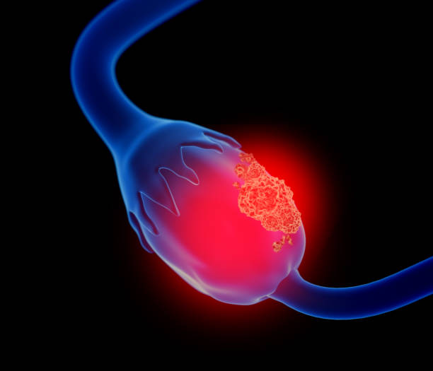 3d illustration of ovarian cancer - ovary imagens e fotografias de stock