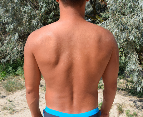 Sunburn on the skin of the back. Exfoliation, skin peels off. Dangerous sun tan.
