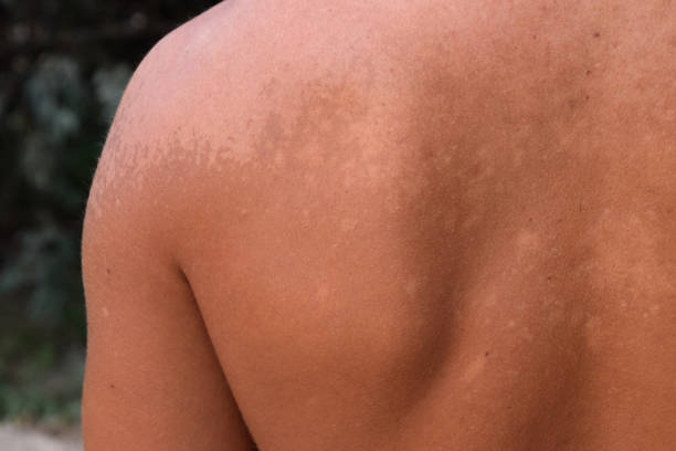 Sunburn on the skin of the back. Exfoliation, skin peels off. Dangerous sun tan Sunburn on the skin of the back. Exfoliation, skin peels off. Dangerous sun tan. leprosy stock pictures, royalty-free photos & images