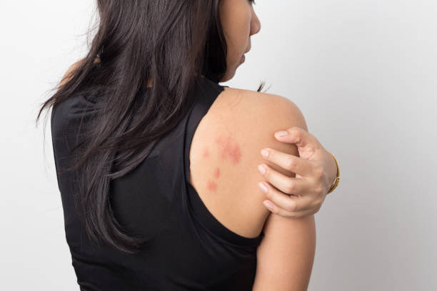 woman showing her skin itching behind , with allergy rash urticaria symptoms stock photo