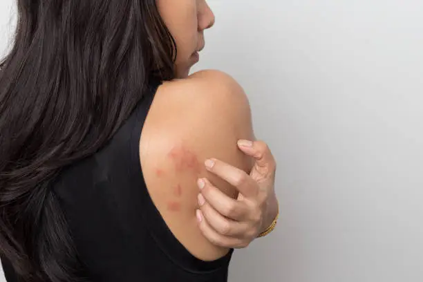 woman showing her skin itching behind , with allergy rash urticaria symptoms