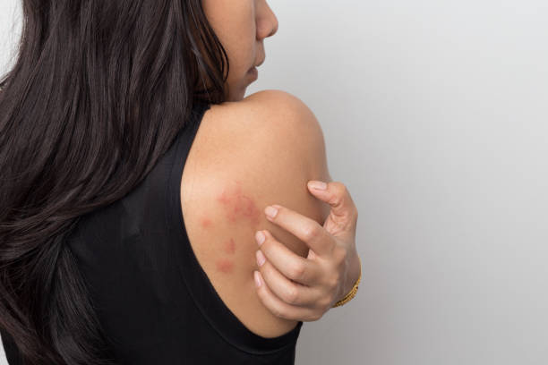 mulher mostrando sua pele coceira atrás, com os sintomas da alergia urticária erupção cutânea - dermatitis dry human hand human skin - fotografias e filmes do acervo