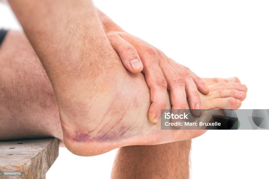 Sprained ankle with bruising isolated on white background Sprain Stock Photo