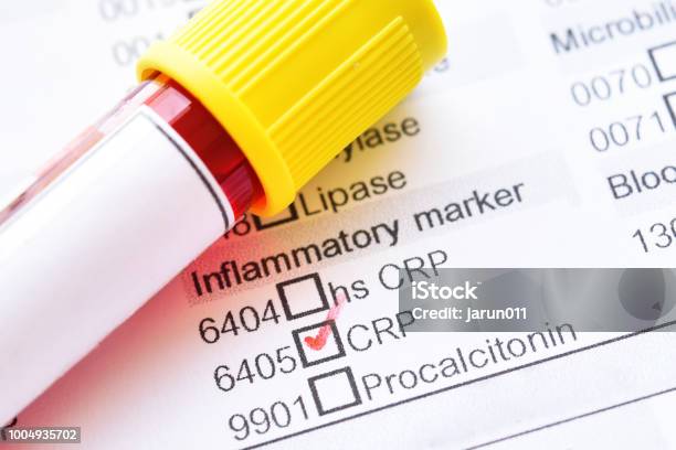 Blood Sample For Creactive Protein Test Stock Photo - Download Image Now - Protein, Biomarker, Medical Exam