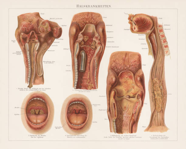 illustrations, cliparts, dessins animés et icônes de maladies de la gorge, chromolitograph, publié en 1897 - thrush yeast fungus illness