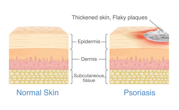 illustrations, cliparts, dessins animés et icônes de couche de la peau normale et peau lorsque plaque psoriasis signes et symptômes apparaissent. - psoriasis