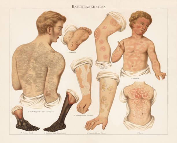 Skin diseases, chromolitograph, published in 1897 Skin diseases: 1) Ichthyosis; 2a) Wet gangrene; 2b) Dry gangrene (Mummification); 3) Pemphigus; 4) Psoriasis; 5) Herpes iris (Herpes zoster); 6) Eczema; 7) Scarlet fever; 8) Measles. Chromolithograph, published in 1897. measles illustrations stock illustrations