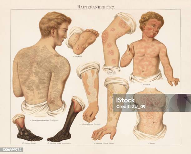 Skin Diseases Chromolitograph Published In 1897 Stock Illustration - Download Image Now - Eczema, Psoriasis, Child