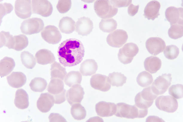istock White blood cells in blood smear 1006691386