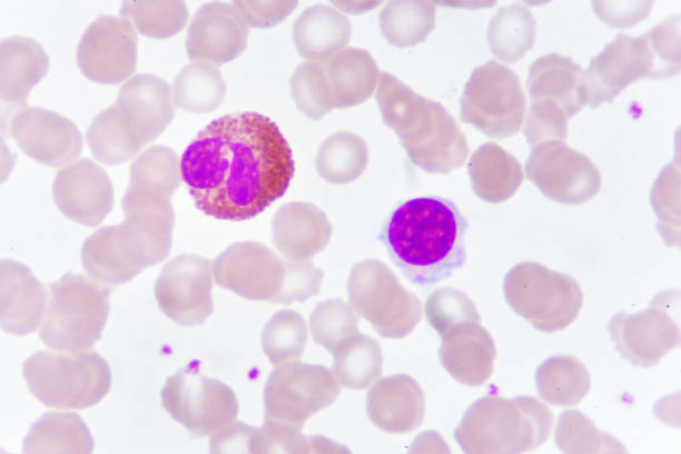istock White blood cells in blood smear 1006691424