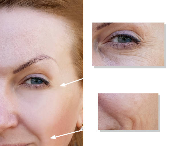 istock face woman wrinkles face before and after procedures 1006816586