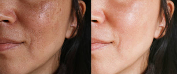 antes y después del concepto del tratamiento facial. cara con melasma y manchas y poros abiertos. - dot gain fotos fotografías e imágenes de stock