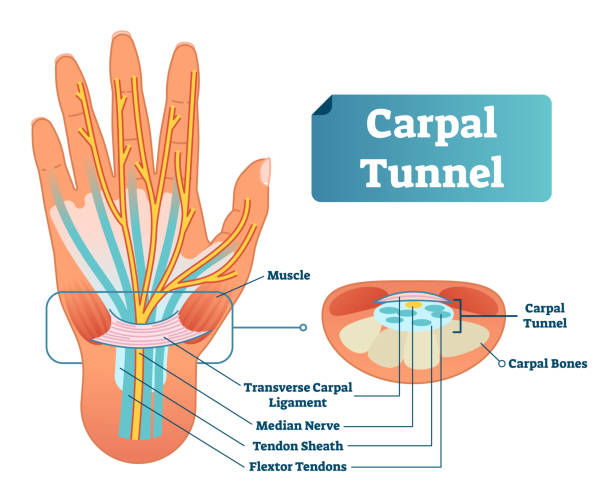 karpaltunnel vektor illustration schema. medizinische beschrifteten diagramm nahaufnahme mit karpal ligamentum, n. medianus, sehnenscheide, flextor sehnen, muskel und knochen. - rheumatism human finger human hand human arm stock-grafiken, -clipart, -cartoons und -symbole