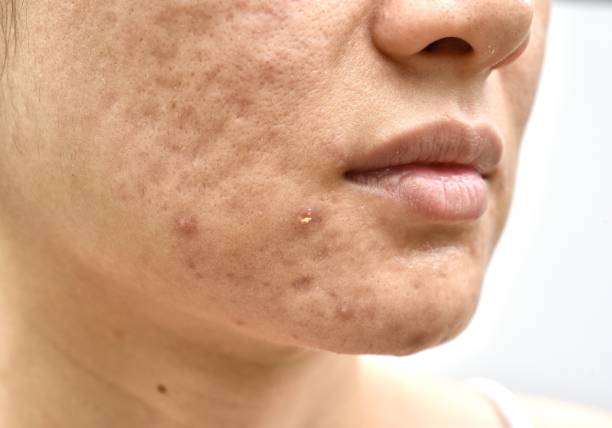 istock Skin problem with acne diseases, Close up woman face with whitehead pimples, Menstruation breakout, Scar and oily greasy face, Beauty concept. 1007056556