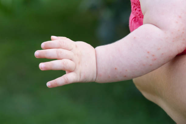 baby hautausschlag verursacht durch fieber, insektenstich, allergie oder hitze hautreaktion - chickenpox skin condition baby illness stock-fotos und bilder