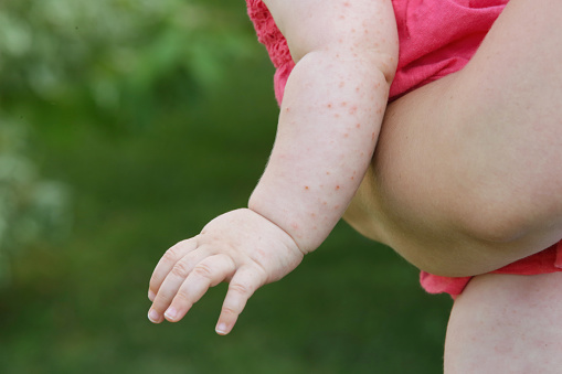 Erupción del bebé causada por fiebre, picadura de insecto, reacción de alergia o calor de la piel photo