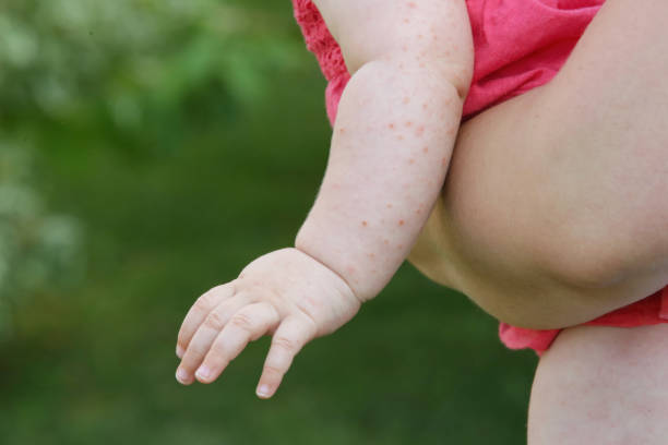 eruzione cutanea causata da febbre, puntura d'insetto, allergia cutanea o reazione termica - chickenpox skin condition baby illness foto e immagini stock