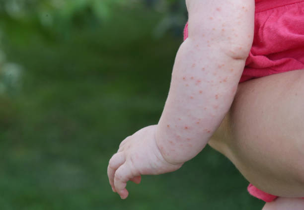 bébé éruption cutanée causée par la piqûre d’insecte, la fièvre, la réaction d’allergie ou de la chaleur cutanée - chickenpox skin condition baby illness photos et images de collection