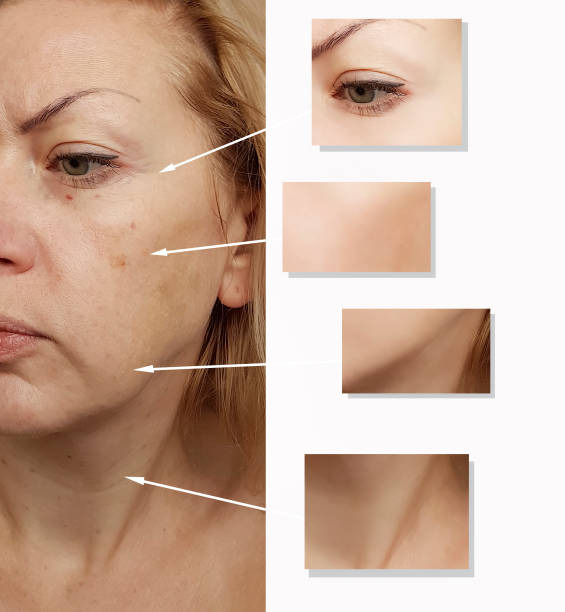 istock woman wrinkles face before and after procedures 1007182094