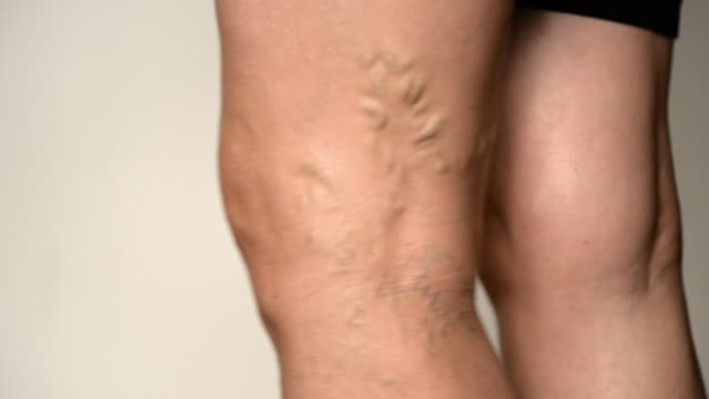 CLOSE UP, MACRO: Twisting veins curving down the back of unrecognizable senior lady's knee