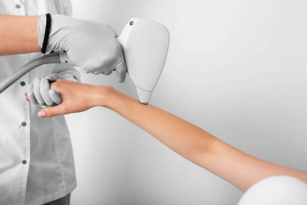 istock laser epilation, hair removal on hands 1007419530