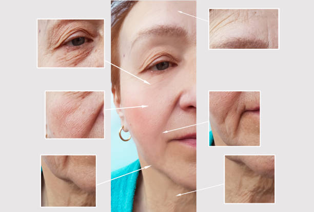 istock woman wrinkles face before and after procedures 1007441912