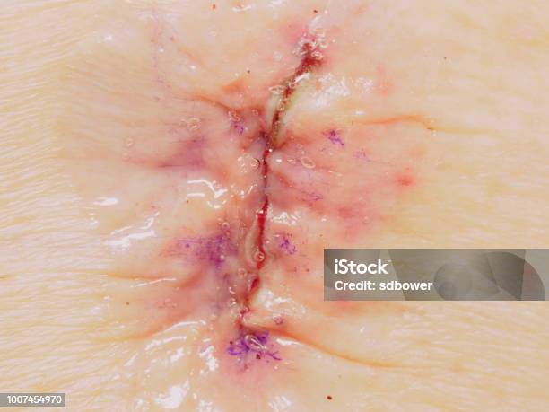 Closeup Image Od Lumbar Laminenecotomy Incision Covered With Dermabond Glue  Stock Photo - Download Image Now - iStock