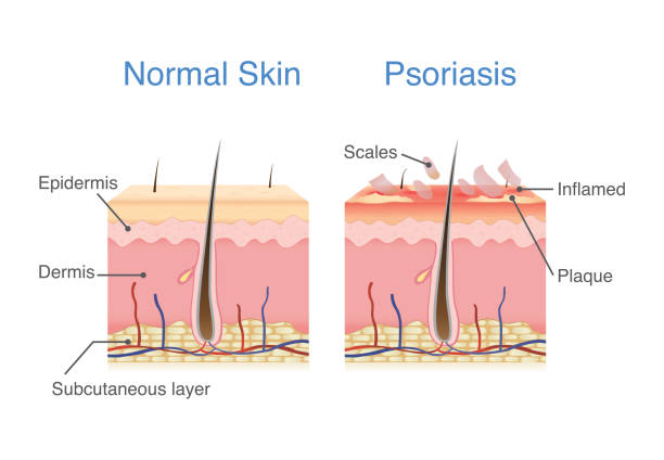 illustrations, cliparts, dessins animés et icônes de couche de la peau normale et peau lorsque plaque psoriasis signes et symptômes apparaissent. - psoriasis