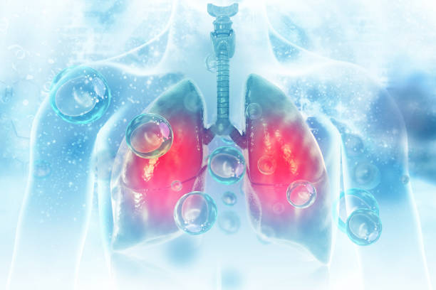 바이러스와 박테리아는 폐 감염. 폐 질환 - 세기관지 뉴스 사진 이미지