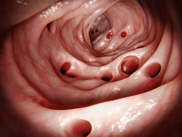 Massive diverticulosis in human intestinte. Diverticulitis results of the inflammation of one of the diverticula. stock photo