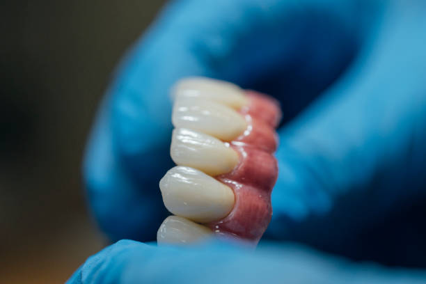 hacer una prótesis dental - dental implant dental hygiene dentures prosthetic equipment fotografías e imágenes de stock