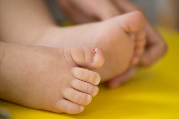 cutting ingrowing baby nails. pedicure