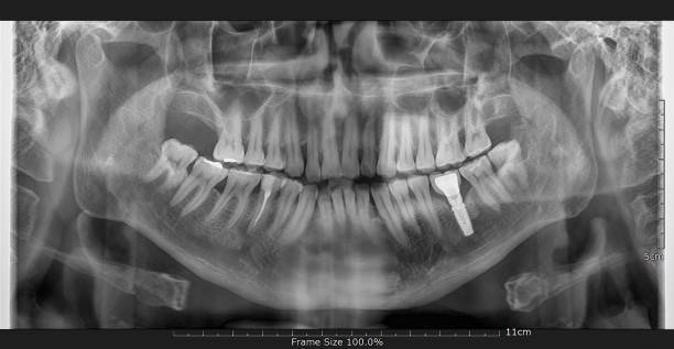 歯とインプラント x 線 - 歯 写真 ストックフォトと画像