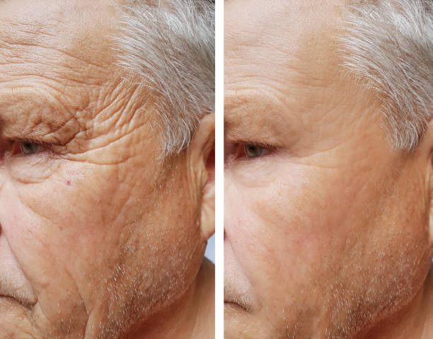 face of an elderly man wrinkles face before and after procedures face of an elderly man wrinkles face before and after procedures botox before and after stock pictures, royalty-free photos & images